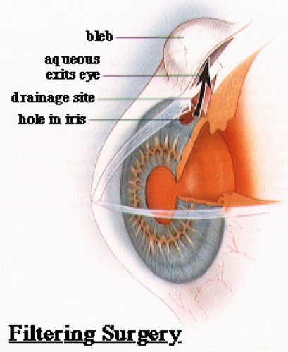 Trabeculectomie
