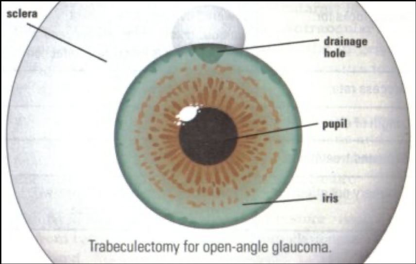 Trabeculectomie